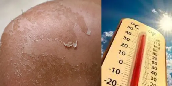 വെന്തുരുകി അയർലണ്ട്, സ്കിൻ കാൻസറും സൂര്യാഘാതവും വ്യാപകം; മുന്നറിയിപ്പ്