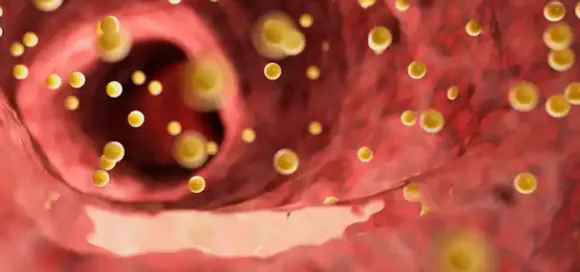 ഭക്ഷണം കഴിക്കുന്നത്, വ്യായാമം ചെയ്യാത്തത്, മദ്യപാനം അല്ലെങ്കിൽ പുകവലി എന്നിവ ഉയർന്ന കൊളസ്ട്രോളിന് നയിച്ചേക്കാം