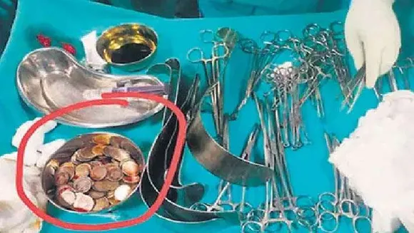 58-കാരന്‍റെ ആമാശയത്തില്‍ നിന്ന് നീക്കം ചെയ്തത്‌ 187 നാണയങ്ങള്‍