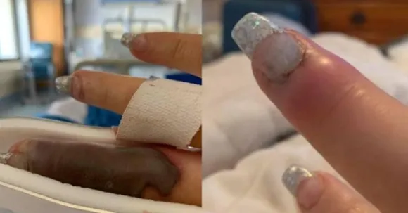 ബ്യൂട്ടിപാര്‍ലറില്‍ മാനിക്യൂര്‍ ചെയ്ത യുവതിയുടെ വിരലുകള്‍ കറുത്തിരുണ്ട് നീരുവച്ചു ഗുരുതരാവസ്ഥയില്‍ 