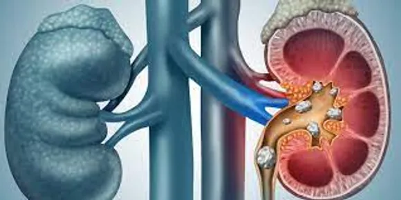 വൃക്കയിലെ കല്ലുകള്‍ തടയാൻ ശ്രദ്ധിക്കേണ്ട കാര്യങ്ങൾ എന്തൊക്കെയാണെന്ന് നോക്കാം..
