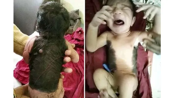 ശരീരത്തിൽ 60 ശതമാനത്തോളവും രോമം, ഒരു കറുത്ത പാട്; അപൂർവ അവസ്ഥയുമായി കുഞ്ഞ് ജനിച്ചു