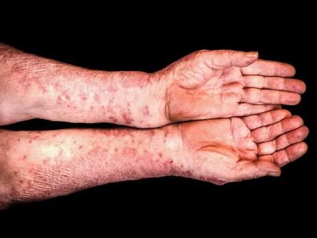 മീസെല്‍സ് വ്യാപകം: റോക്ക്‌ലാന്റ് കൗണ്ടിയില്‍ അടിയന്തരാവസ്ഥ