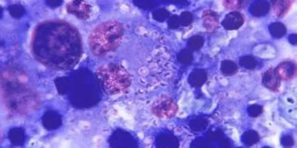 രോഗികളിൽ ചികിത്സ-പ്രതിരോധശേഷിയുള്ള റിംഗ് വോമിന്റെ ആദ്യകേസുകൾ കണ്ടെത്തി