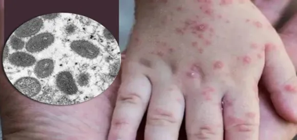 ആശങ്ക; യുഎഇയില്‍ മൂന്ന് പേര്‍ക്ക് കൂടി കുരങ്ങുപനി