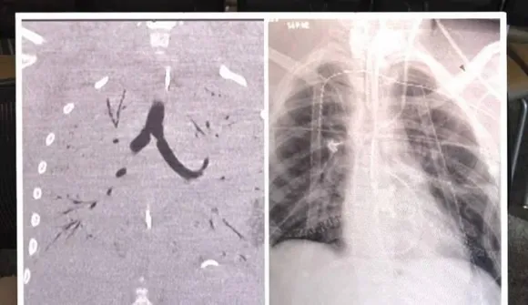 ലോകത്തിലെ ആദ്യ ഇരട്ട ശ്വാസകോശ മാറ്റിവയ്ക്കല്‍ ഡിട്രോയിറ്റില്‍