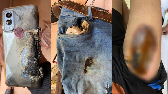 പോക്കറ്റിലിരുന്ന ഫോൺ പൊട്ടിത്തെറിച്ചു: പരാതിയുമായി യുവാവ് രംഗത്ത്, അന്വേഷിക്കുമെന്ന് വൺ പ്ലസ്