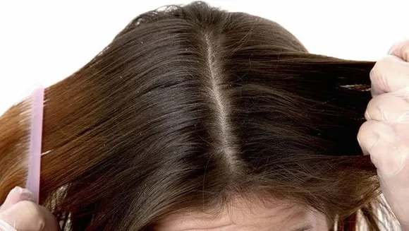 താരന്‍റെ ശല്യം രൂക്ഷമാകുന്നോ ? താരനകറ്റാന്‍ വീട്ടില്‍ത്തന്നെ ചെയ്യാവുന്ന ചില എളുപ്പമാര്‍ഗ്ഗങ്ങളിതാ ..