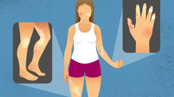 Scleroderma | credit: Michigan Medicine.png