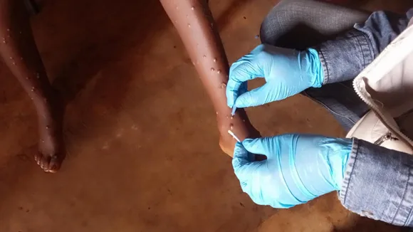 mpox