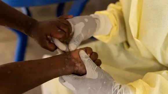 mpox virus