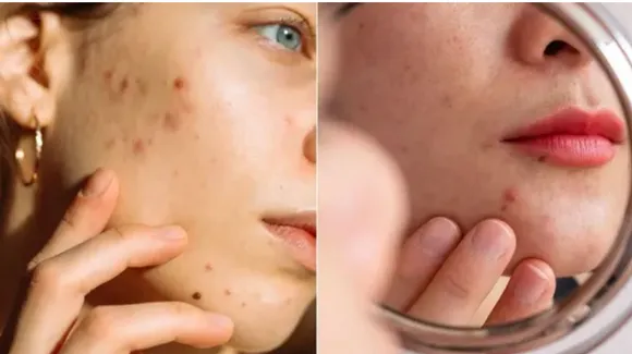 Fade Acne Marks with an Effective Cream for Clearer, Even Skin