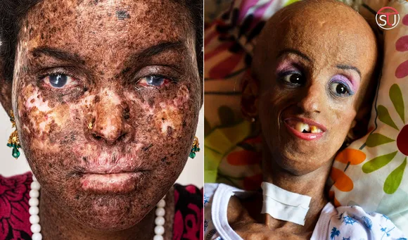 Top 10 Rare Diseases In The World That Are Dangerous And Scary