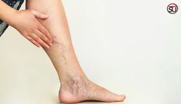 Varicose Veins: Symptoms, Causes and Treatment