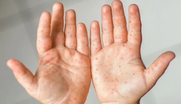 Alert Parents! New Tomato Fever Infecting Only Kids, Causing Painful Blisters on Body