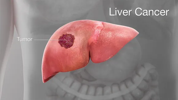 Liver Cancer : Causes, Symptoms, Treatment And Risk Factors Of Cancer