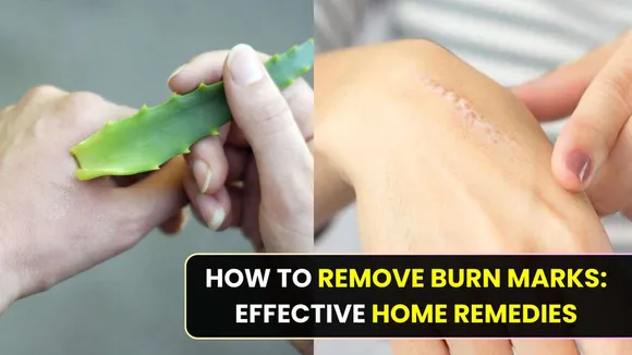 How to remove burn marks: effective home remedies