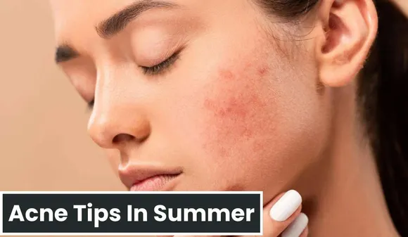 Acne Tips In Summer: If you often Struggle with Acne in Summer, Then Keep these Things in Mind