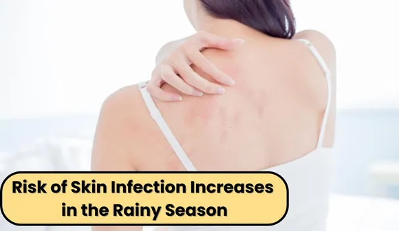 The Risk of Skin Infection Increases in the Rainy Season, Adopt these Healthy Habits to Avoid it