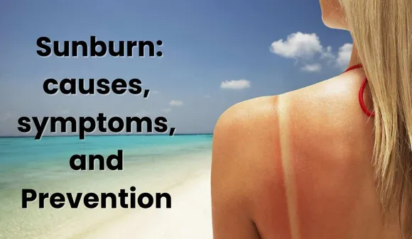 Understanding Sunburn: causes, symptoms, and Prevention
