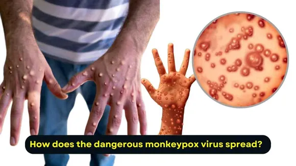 Understanding Monkeypox: Symptoms, Transmission, and How to Stay Safe