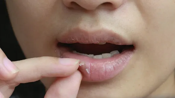 Say Goodbye to Dry Lips with These Natural Winter Remedies