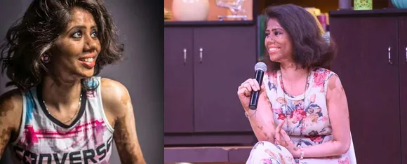 vitiligo model ramya