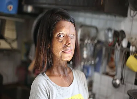acid attack, acid attack victims, courage,