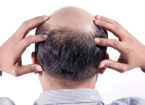 Hair transplant