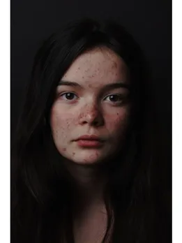 acne poster - unsplash (1)