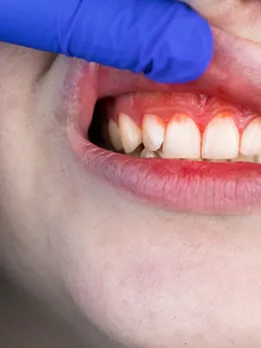 bleeding gums - unsplash (1)