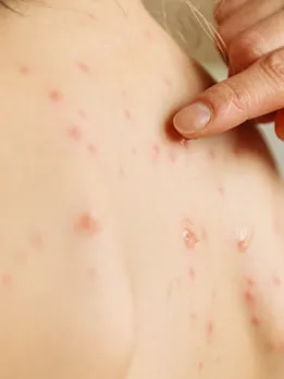 body acne - unsplash (1)