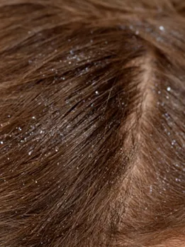 dandruff 2 - usnplash (1)