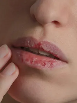 dry lips - unsplash (1)