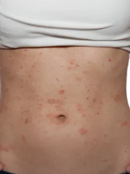 eczema 2 - unsplash (1)
