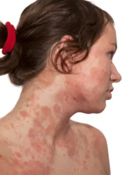 eczema 3 - unsplash (1)