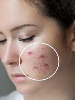 pimples - unsplash (1)