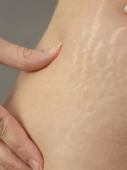 stretch marks - unsplash (1)