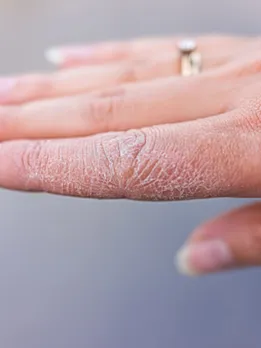 dry skin 4 - unsplash (1)