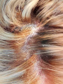 scalp soriasis 3 - unspalsh (1)