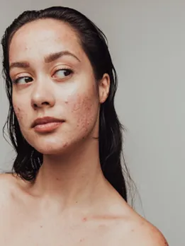 acne 14 - unsplash (1)