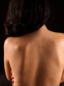 body acne 1 - unsplash (1)