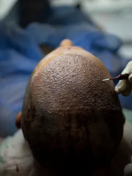 hair transplant 4 - unsplash (1)