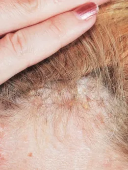 scalp soriasis 2 - unspalsh (1)