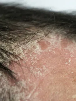 scalp soriasis 4 - unsplash (1)