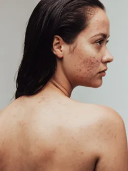acne 16 - unsplash (1)