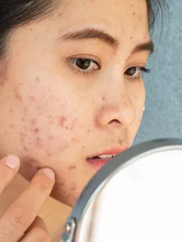 acne - 2 unsplash (1)