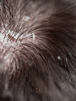 dandruff 4 - unsplash (1)
