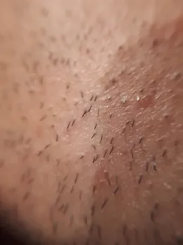 ingrown hair 4 - unsplash (1)