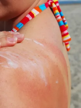 sun burn 1 - unspalsh (1)
